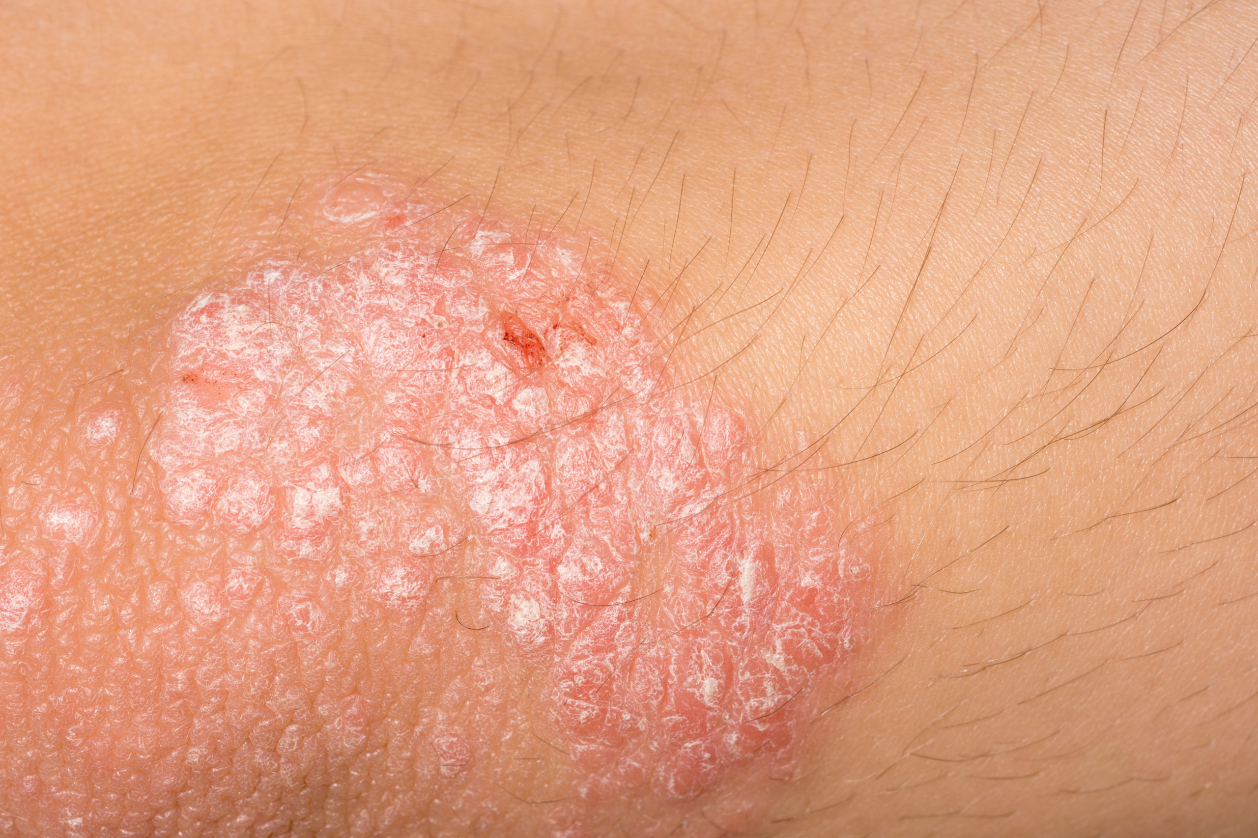 Psoriasis Treatment