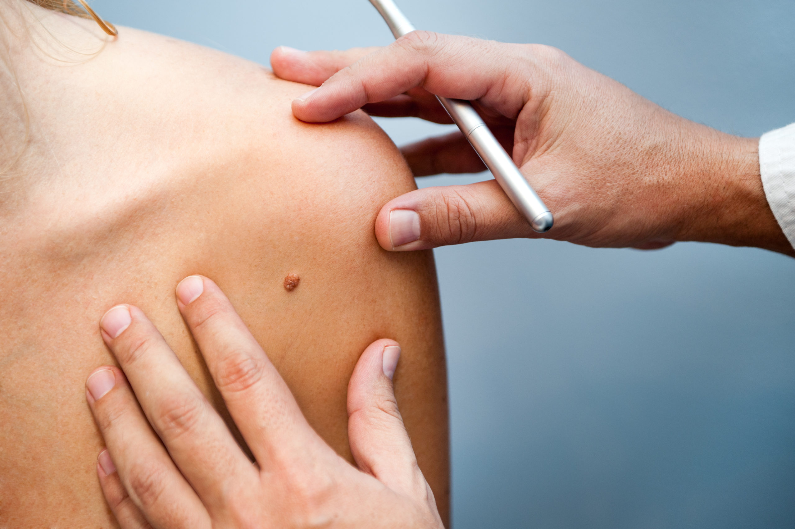 Skin Cancer Screening