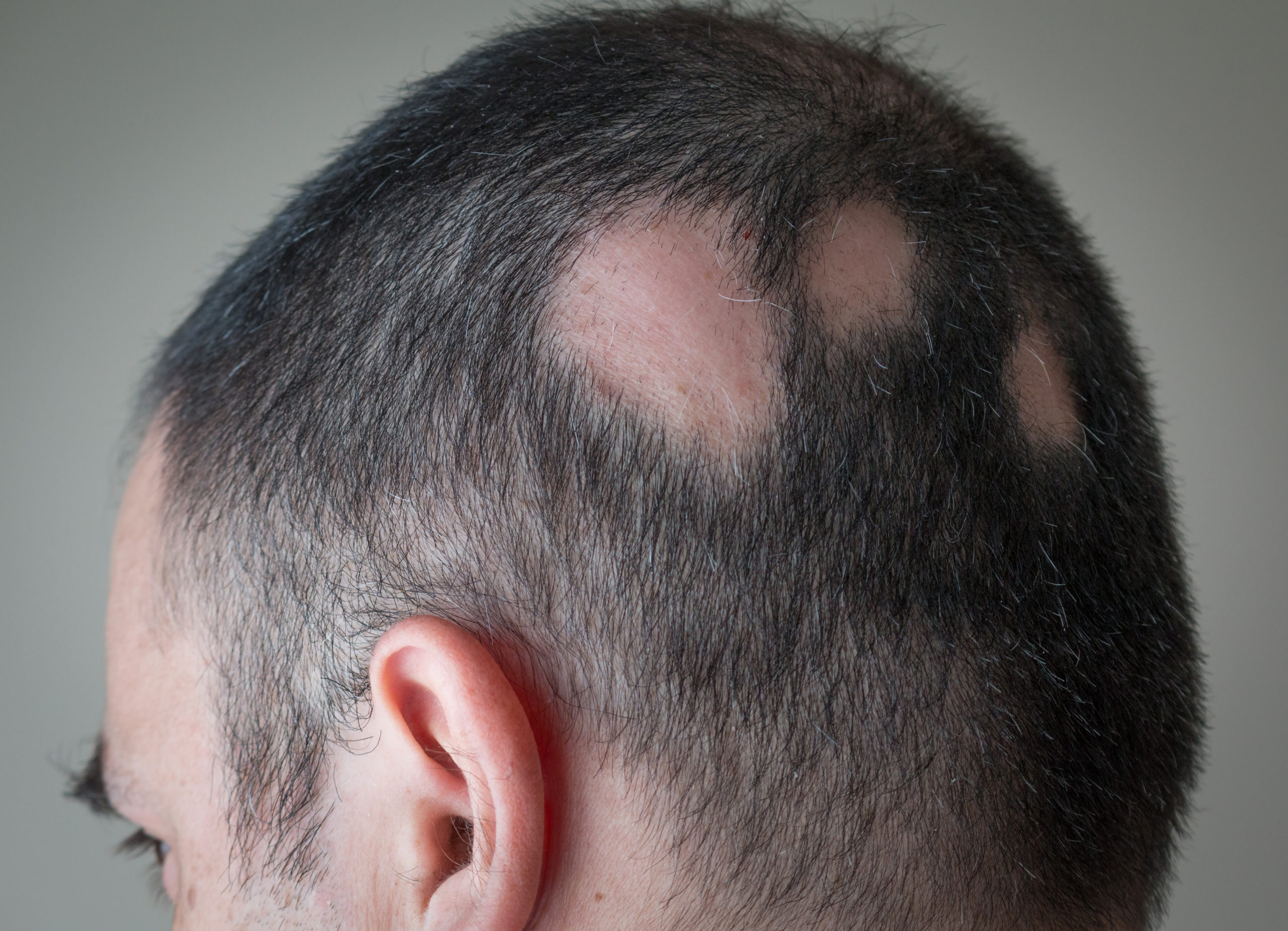 Alopecia Areata Treatment