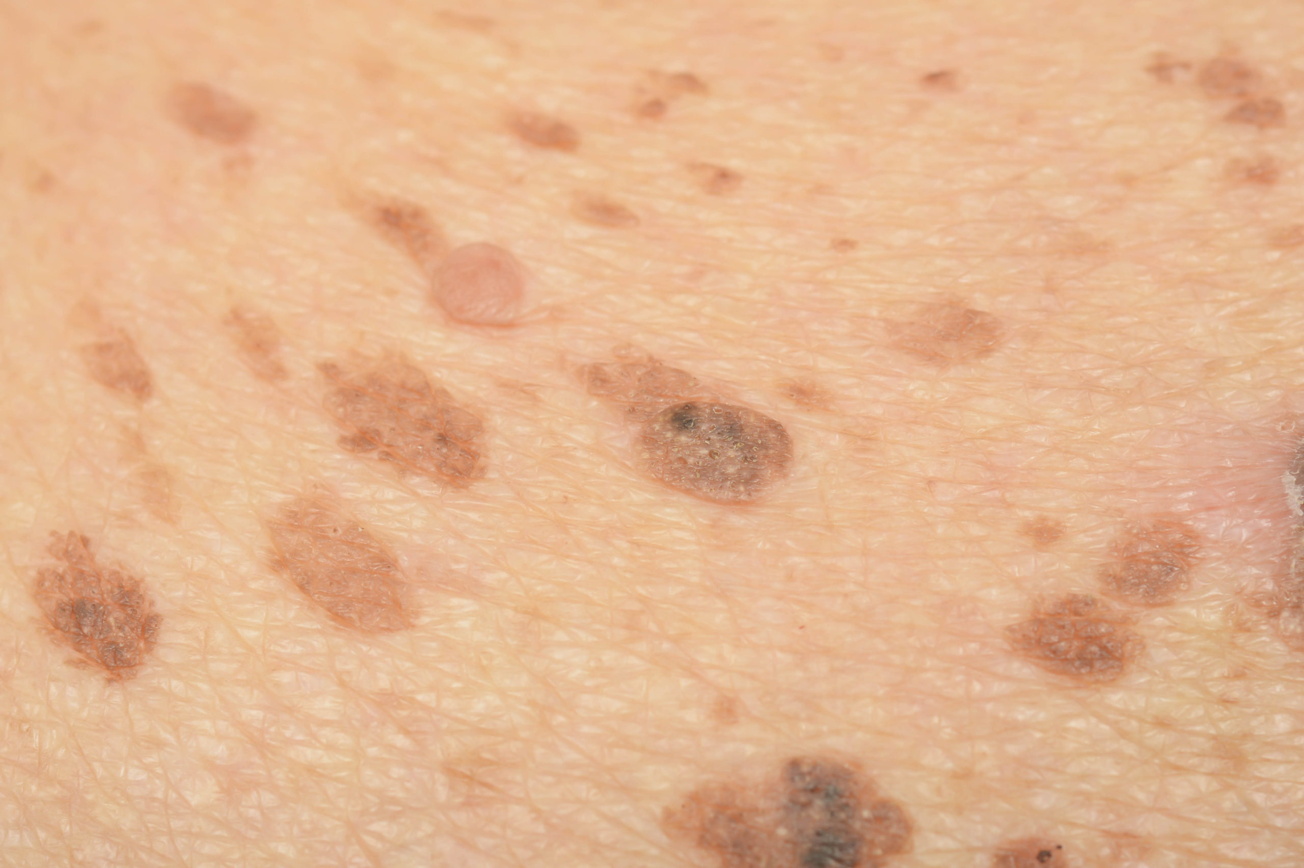 Squamous Cell Carcinoma Treatment