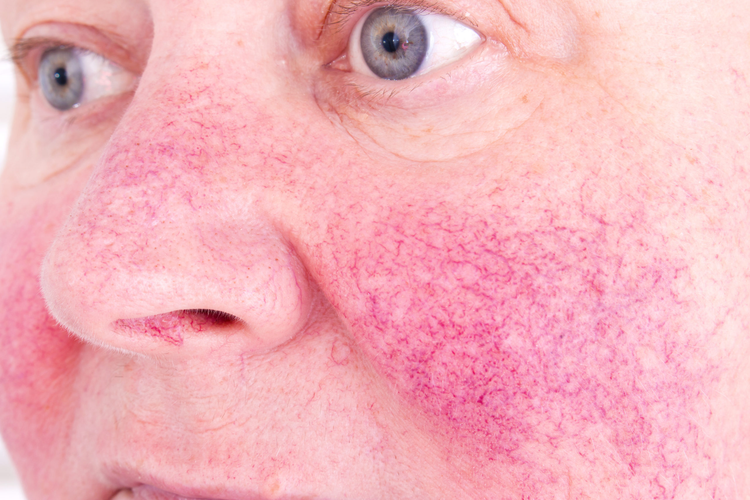 Rosacea Treatment