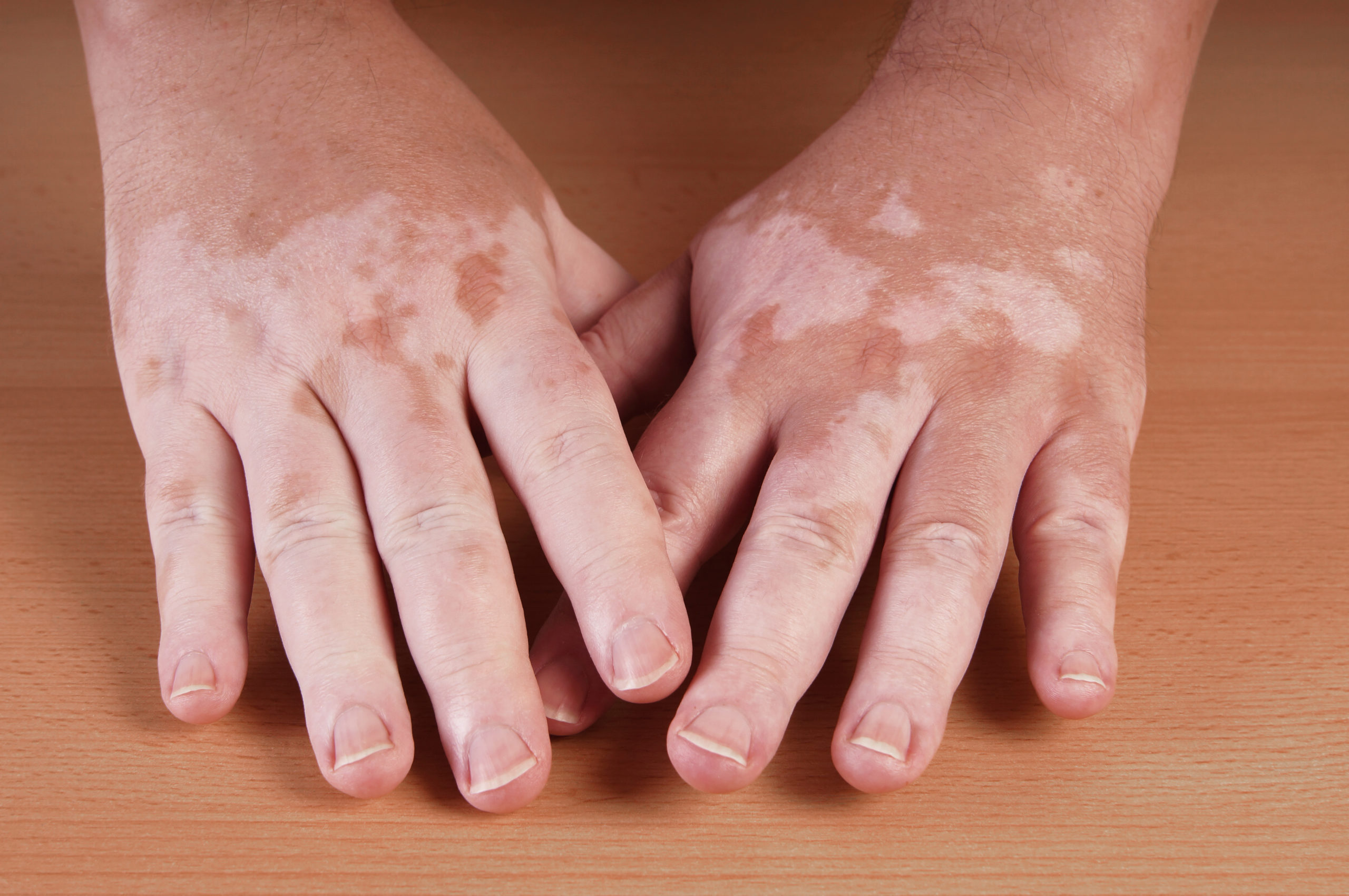 Vitiligo (Skin Pigment Disorders)