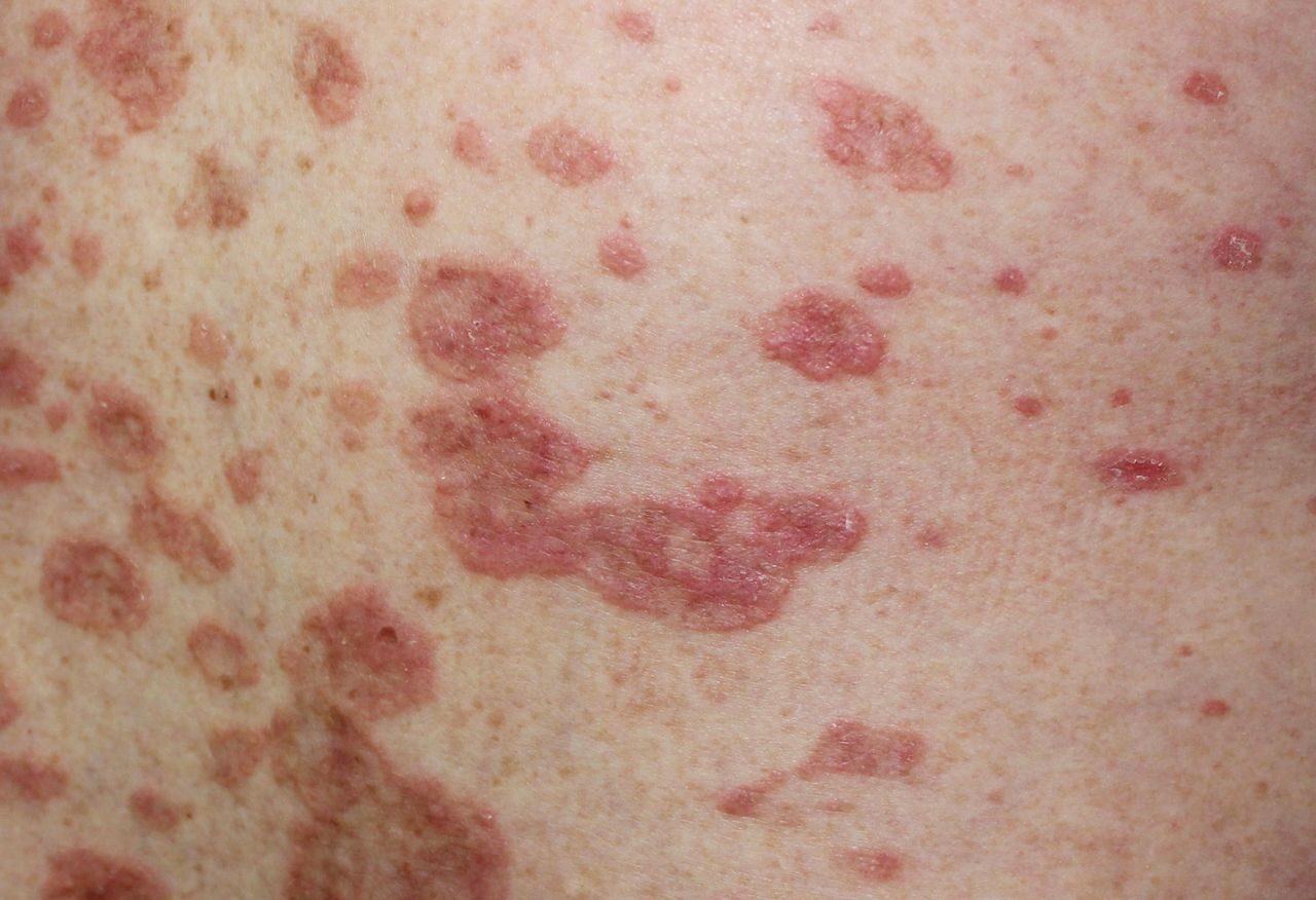 Lichen Planus Treatment