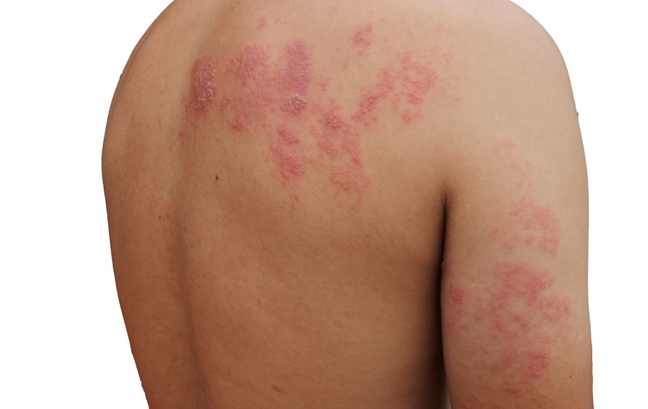 Shingles Treatment