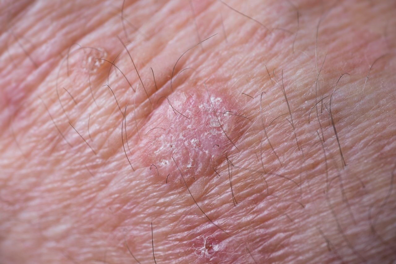 Actinic Keratoses Treatment