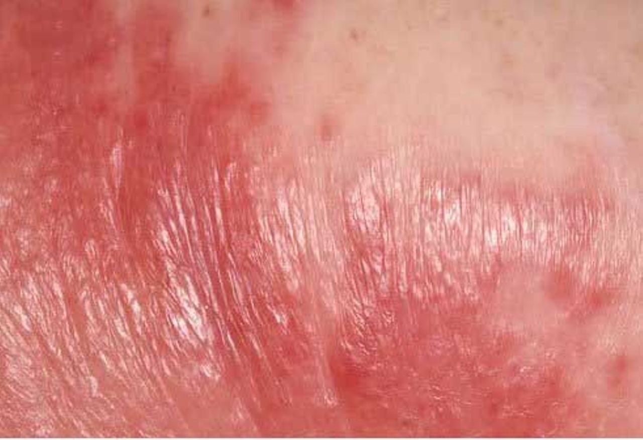 Cellulitis Treatment