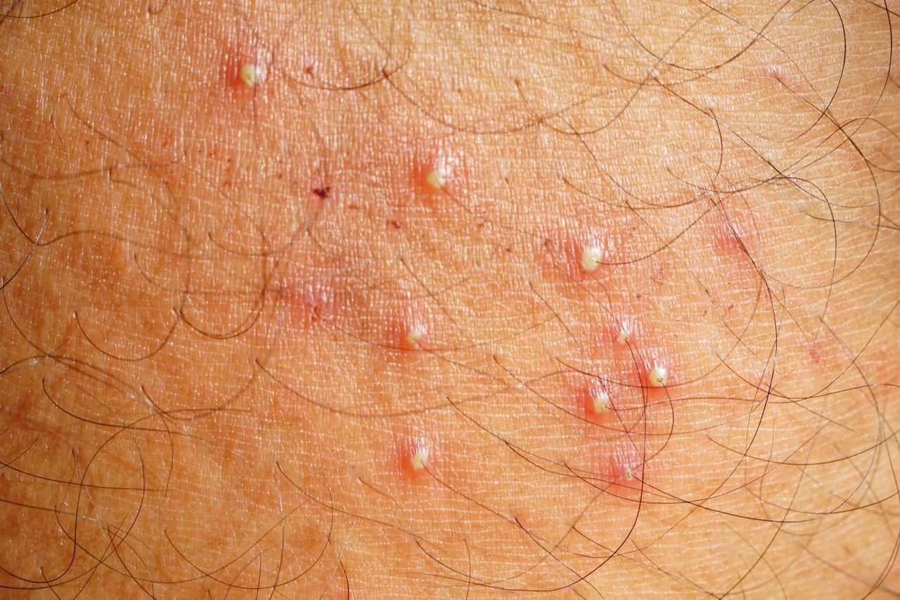 Ingrown Hairs & Folliculitis Treatment