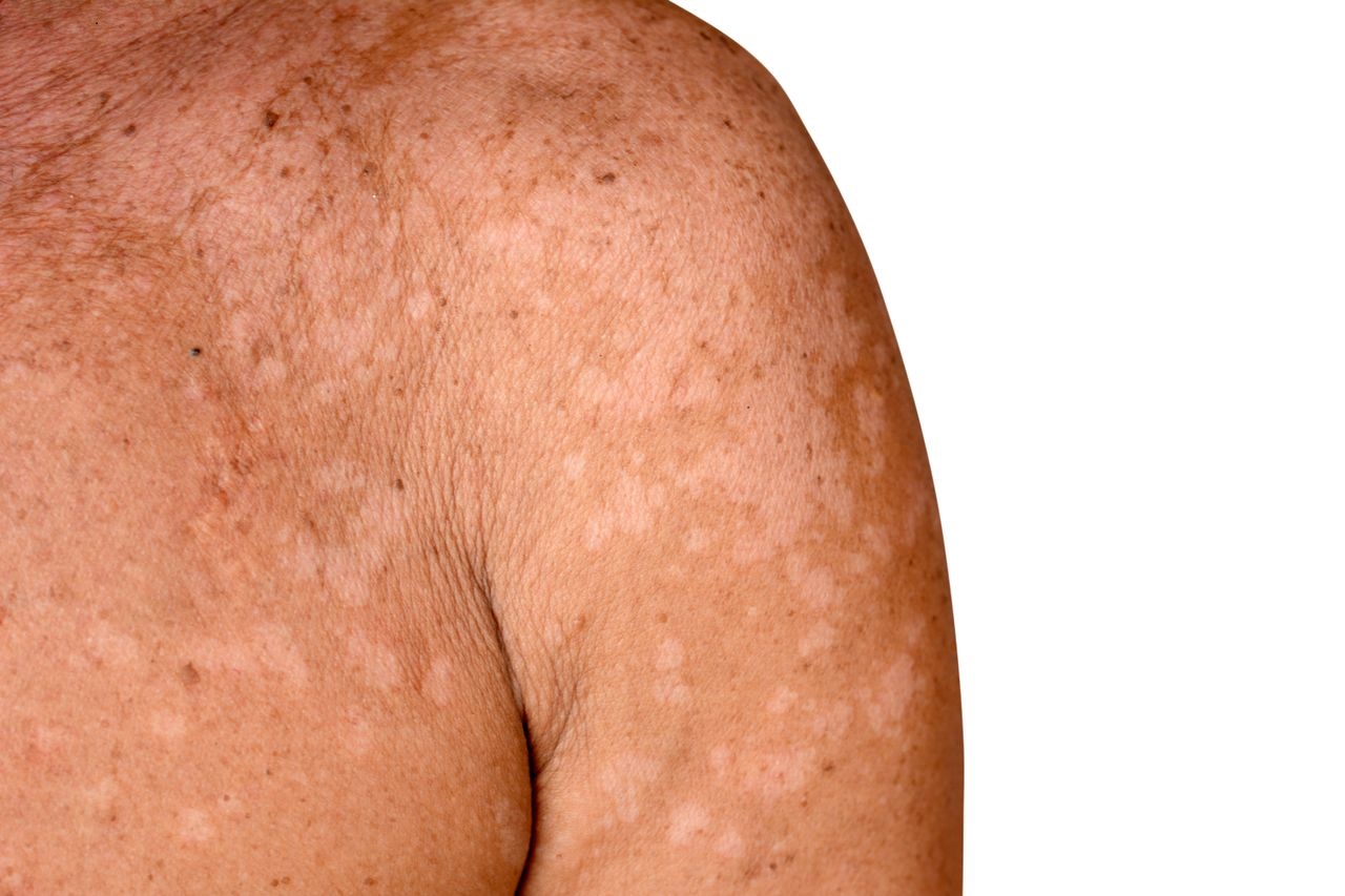 Fungal Skin Infection Treatment FL