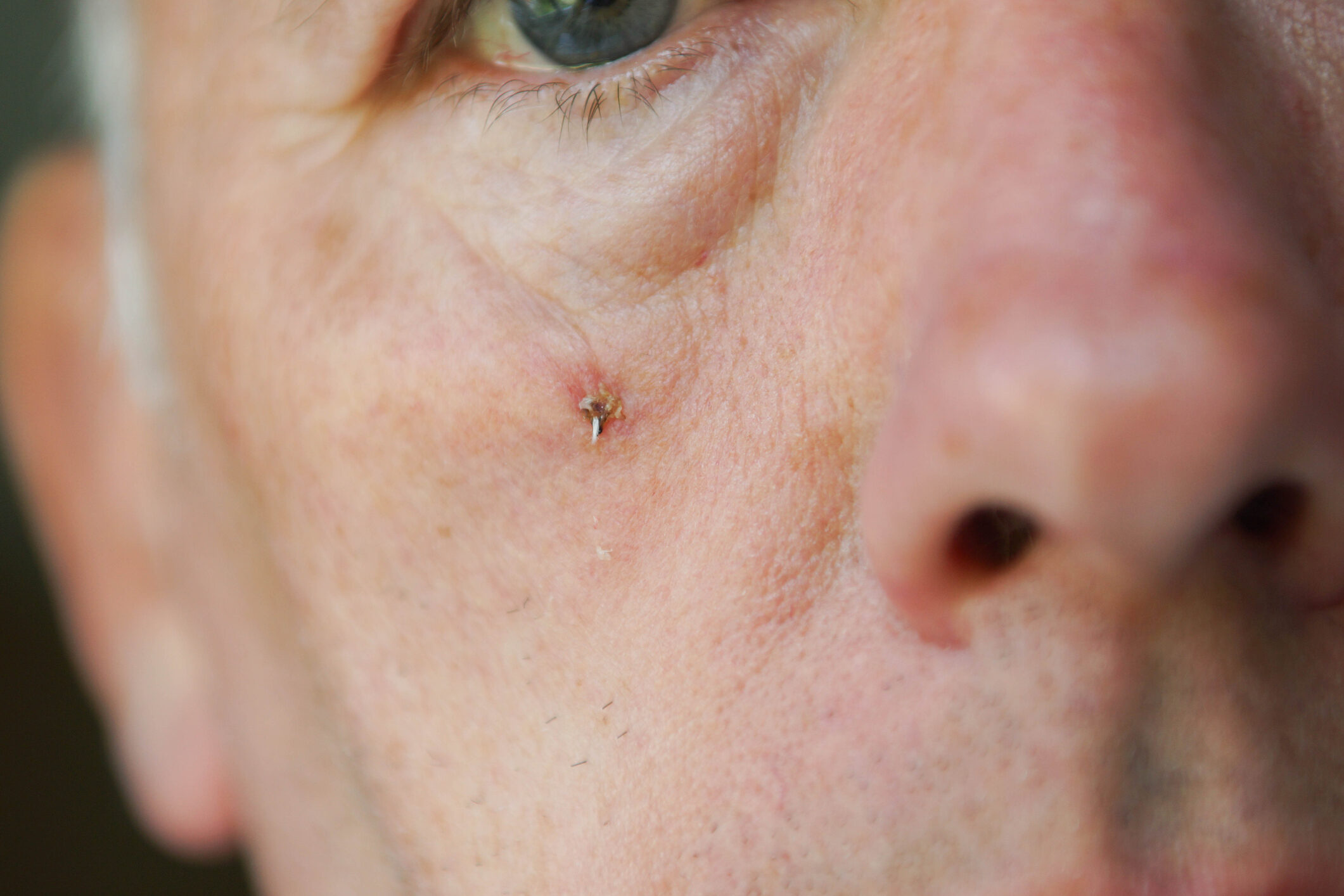 Seborrheic Keratosis Removal