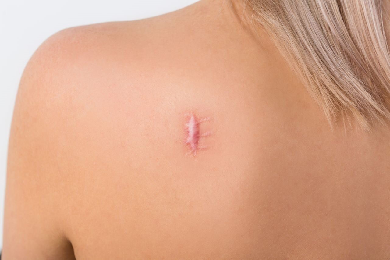 Keloid Scar Treatment