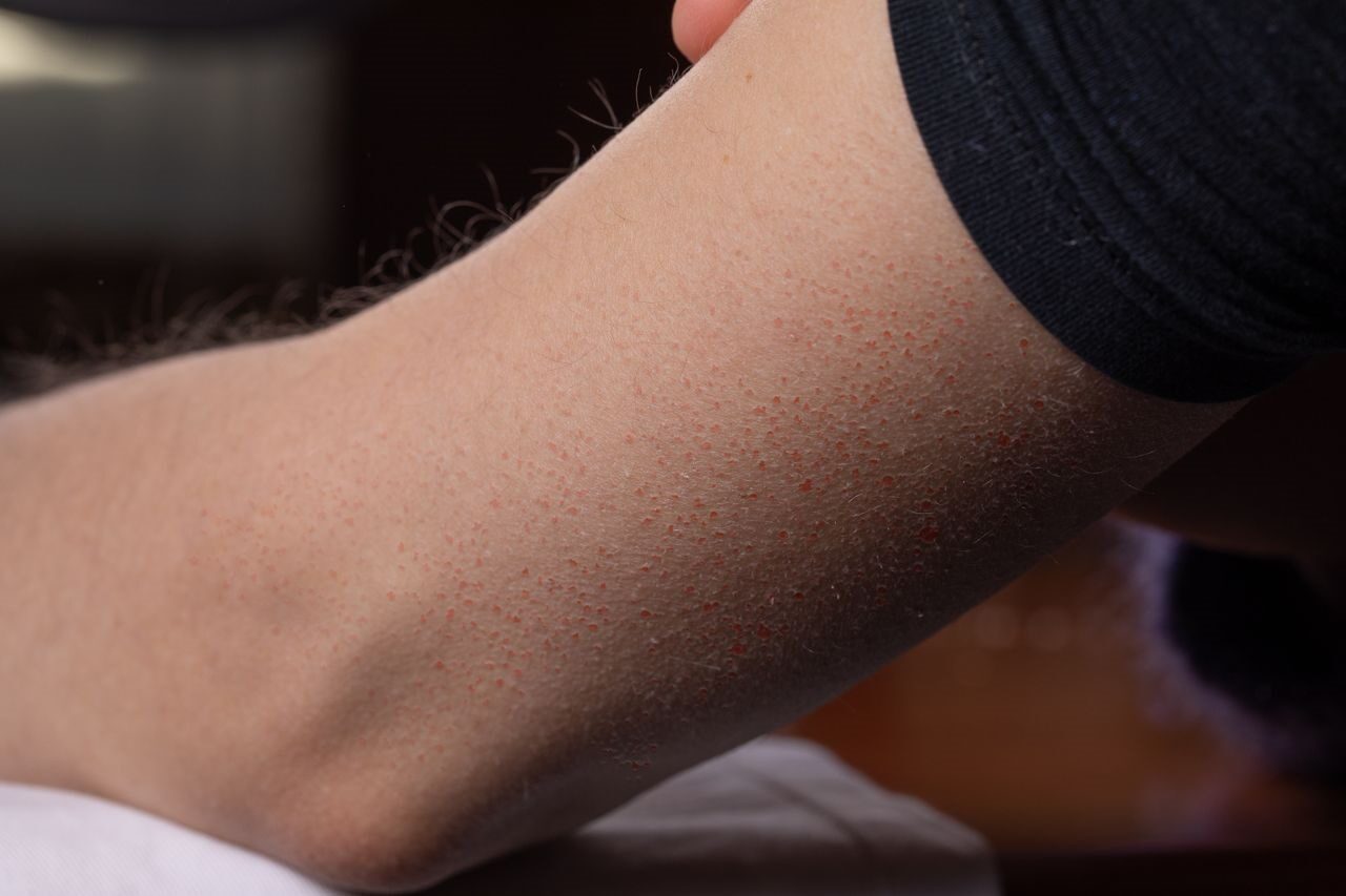 Keratosis Pilaris Treatment