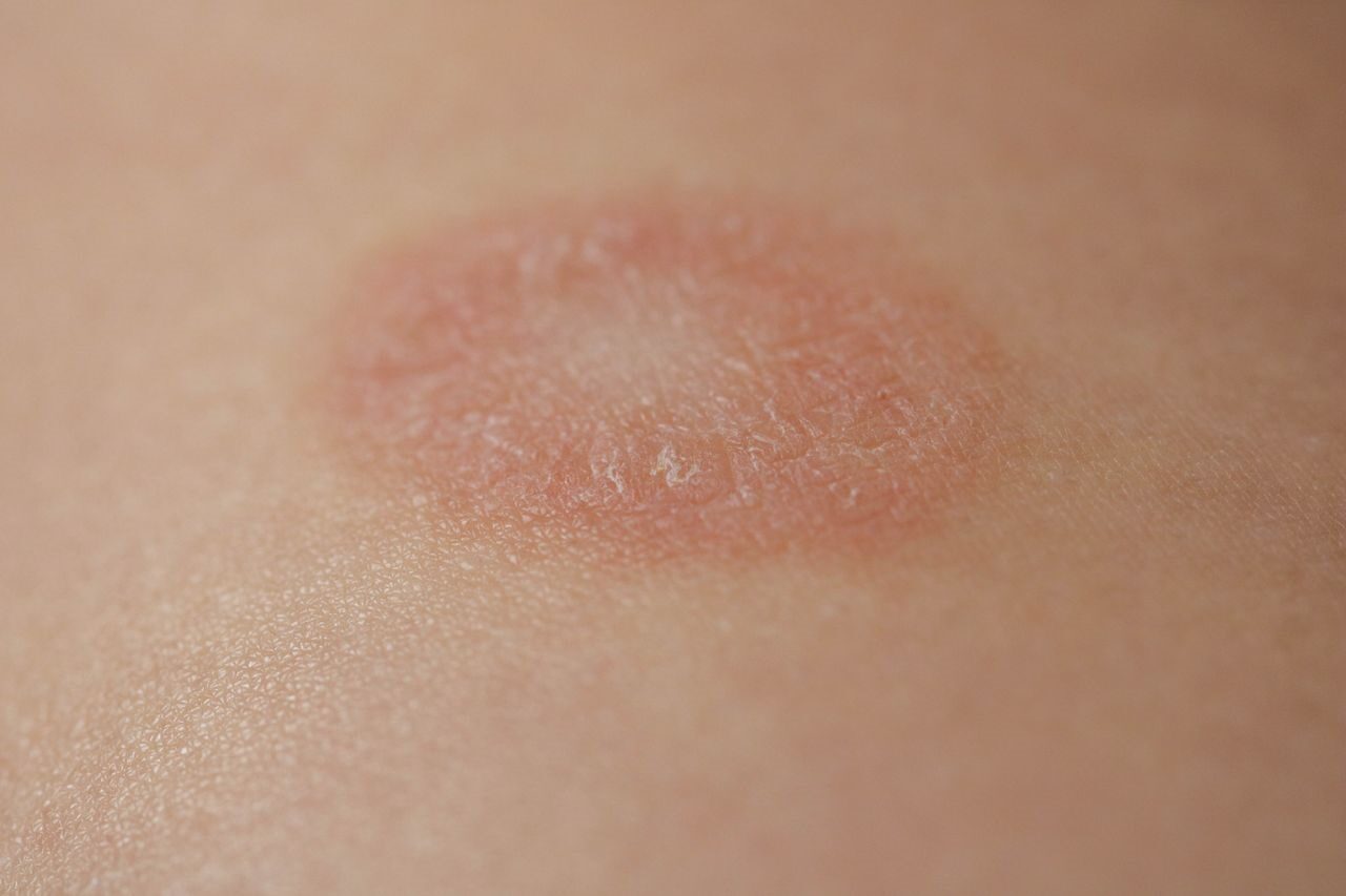 Pityriasis Rosea Treatment