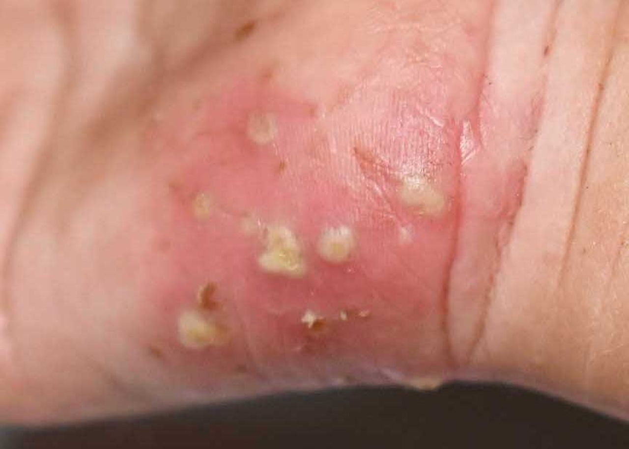 Scabies Treatment