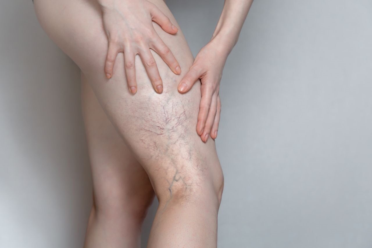 Spider Vein Treatment