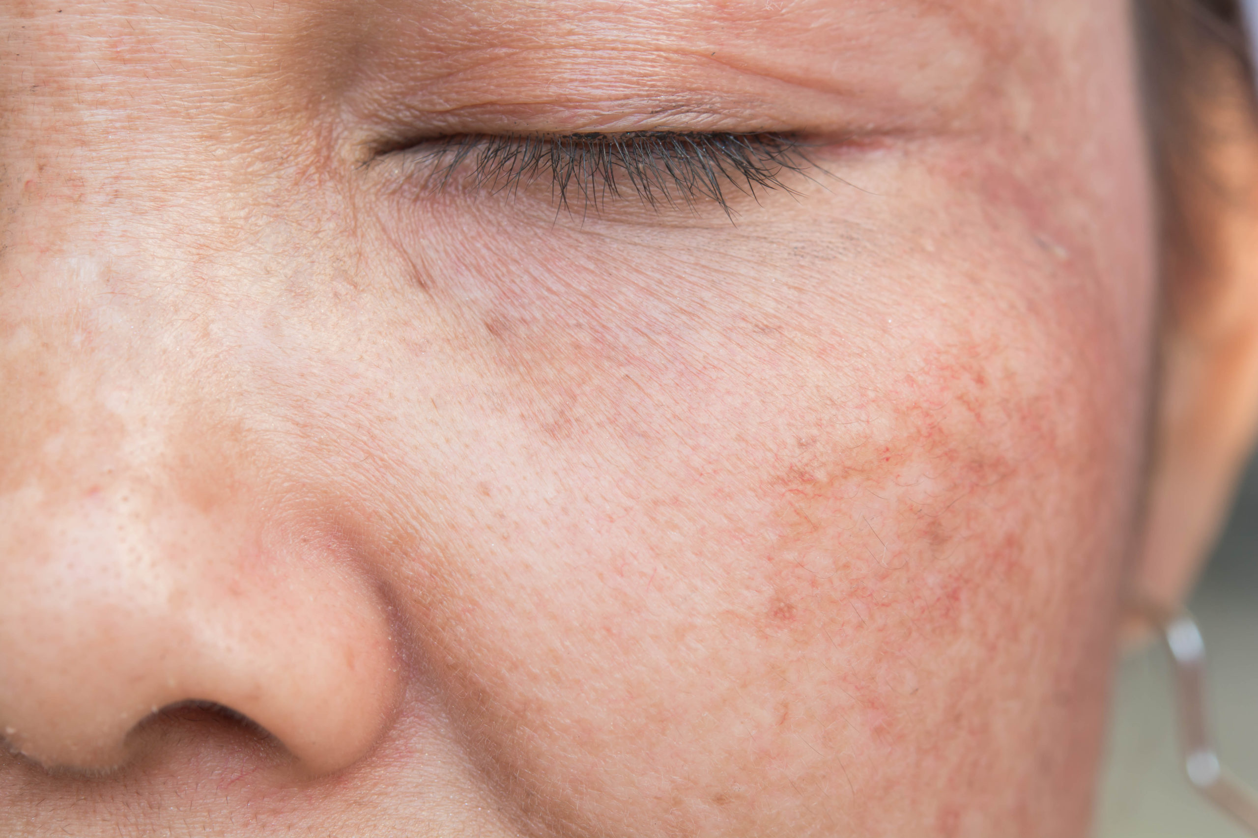 Age Spots & Sunspots Removal