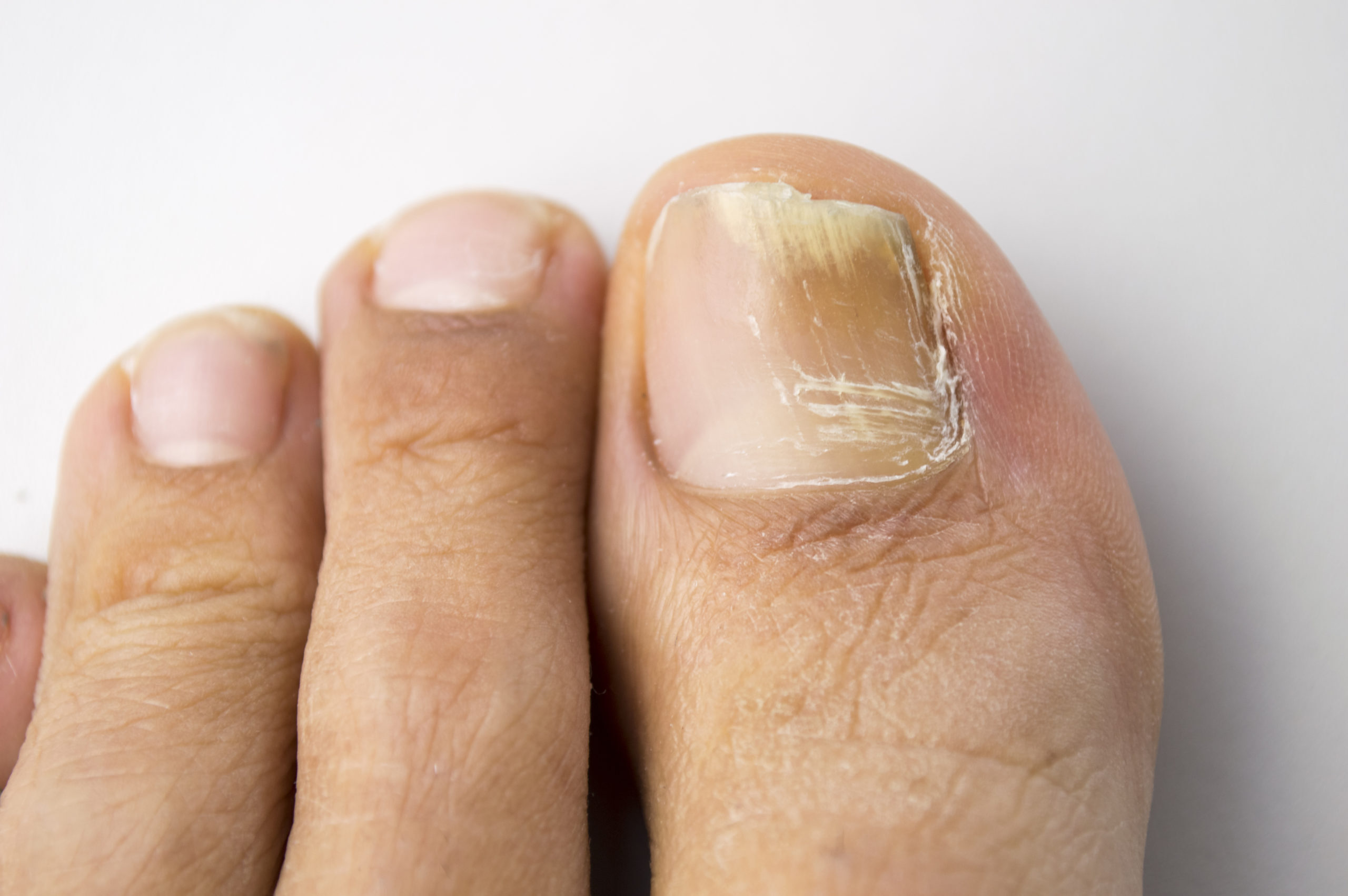 Nail Disorder Treatment