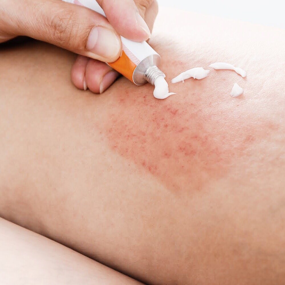 Skin Allergy Treatment