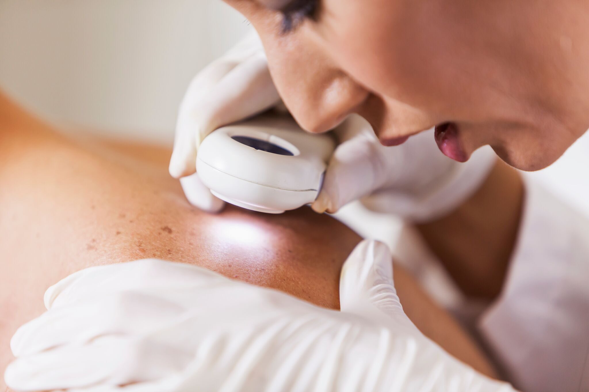 Melanoma Treatment