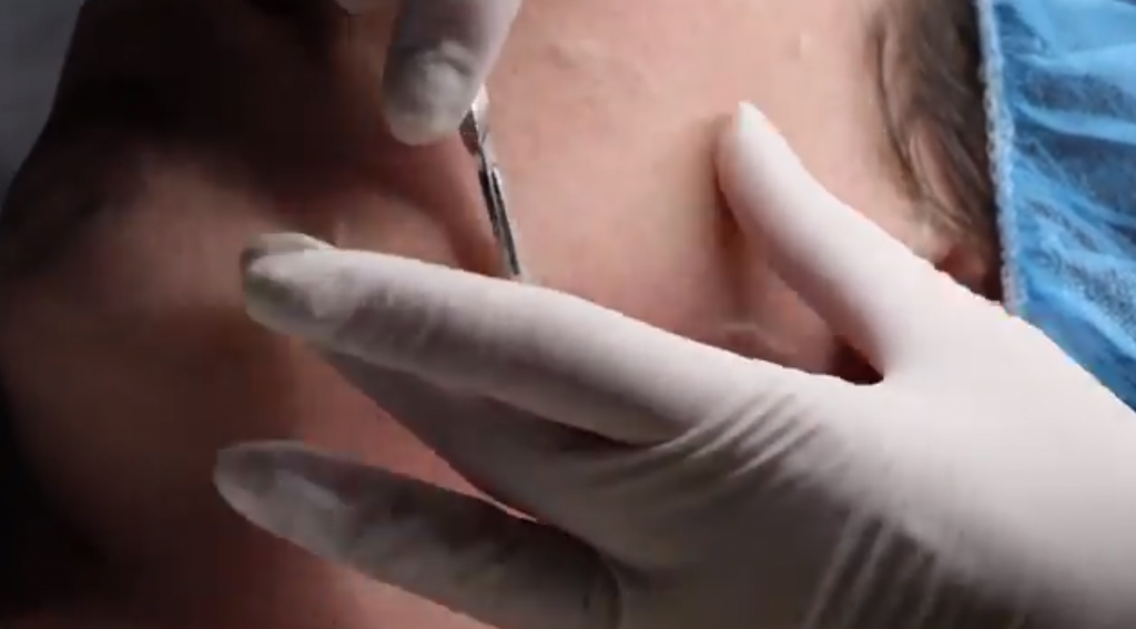 Dermaplaning Treatment